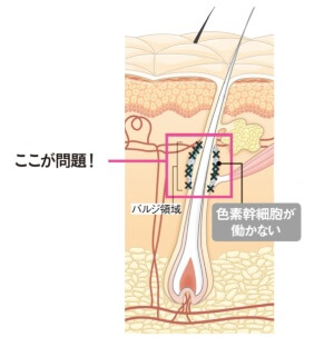 原因として注目される「酸化ストレス」